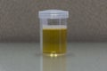 Urine for examination in laboratory