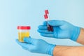 Urine sample and blood flask test in doctor or laboratory technician hands
