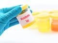 Urine sample for microalbumin test Royalty Free Stock Photo