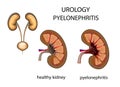 Urology, kidney, pyelonephritis Royalty Free Stock Photo