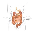 Urostomy following bladder surgery or obstruction