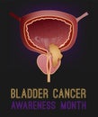 Urothelial carcinoma portrait poster. Urinary bladder cancer banner.