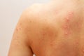 Urticaria allergy on skin back, close up