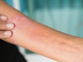 Urticaria on hand woman non-lethal type from food and air poisoning