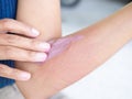 Urticaria on hand woman non-lethal type from food and air poisoning. she apply Calamine Lotion medicine on the arm her.she Sick, Royalty Free Stock Photo