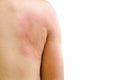 Urticaria - isolated on white background with clipping path.