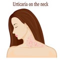 Urticaria on the neck