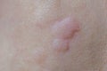 Urticaria on the skin. Red spots of an allergic reaction on the skin of a child. Urticaria symptoms close up Royalty Free Stock Photo