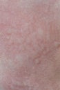 Urticaria on the skin. Red spots of an allergic reaction on the skin of a child. Urticaria symptoms close up Royalty Free Stock Photo