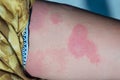 Urticaria on woman leg