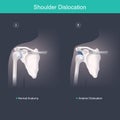 This is use for explain and compare when the head of the humerus is out of the shoulder joint include shoulder pain. Anatomy body Royalty Free Stock Photo