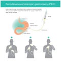 Percutaneous endoscopic gastrostomy PEG