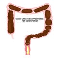 Use of laxatives rectal suppositories for constipation. Feces in colon. Infographics. Vector illustration on isolated