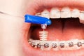 Using interdental brush for orthodontic braces Royalty Free Stock Photo