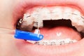 Using an interdental brush for orthodontic braces Royalty Free Stock Photo