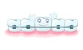 Using of metallic dental braces, orthodontic brackets to correct occlusion, alignment of dentition.