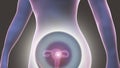 Uterine cancer, illustration