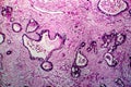 Uterine cancer, light micrograph