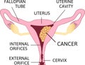 Uterine Cancer Vector Poster or Chart with Cancerous Tumor Cells on Endometrium Tissue of Uterus