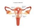 Uterine fibroid
