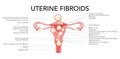 Uterine fibroids Female leiomyomas reproductive system uterus diagram with inscriptions in Latin text. Human anatomy