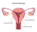 Uterine Fibroids Illustration Royalty Free Stock Photo