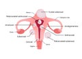 Uterine fibroids, noncancerous growths of the uterus. Different locations inside womb subserosal, submucosal, pedunculated, Royalty Free Stock Photo