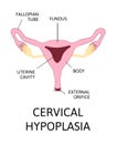 Uterine hypoplasia, naive uterus or infantile uterus Royalty Free Stock Photo