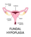 Uterine hypoplasia, naive uterus or infantile uterus Royalty Free Stock Photo