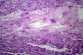 Uterine leiomyoma, light micrograph Royalty Free Stock Photo