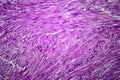 Uterine leiomyoma, light micrograph Royalty Free Stock Photo