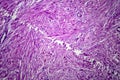 Uterine leiomyoma, light micrograph Royalty Free Stock Photo