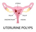 Uterine polyps. Human realistic uterus. Anatomy illustration Royalty Free Stock Photo