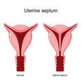 Uterine septum. female reproductive system.