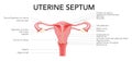 Uterine septum septate uterus Female reproductive system diagram with inscriptions text. Front view in a cut. Human Royalty Free Stock Photo