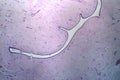 Uterus adenofibroma, light micrograph Royalty Free Stock Photo