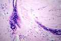 Uterus adenofibroma, light micrograph Royalty Free Stock Photo