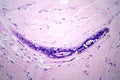 Uterus adenofibroma, light micrograph