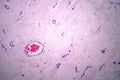 Uterus adenofibroma, light micrograph Royalty Free Stock Photo