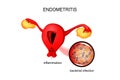 The uterus affected by endometriosis