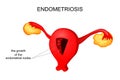 The uterus affected by endometriosis
