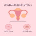 Uterus and cervical erosion