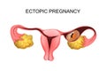 Uterus with ectopic pregnancy Royalty Free Stock Photo