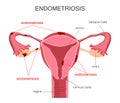 Uterus Endometriosis Diagram Royalty Free Stock Photo