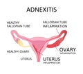 Uterus and ovaries scheme, adnexitis - infection and inflammation in the fallopian tube and ovary. Uterus inflammation