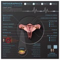 Uterus And Ovary Anatomy System Medical Infographic Infochart Royalty Free Stock Photo