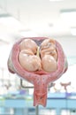 Uterus with twin fetus