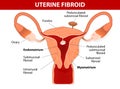 Uterus & types of fibroids Royalty Free Stock Photo