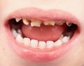 Uthealthy teeth Royalty Free Stock Photo