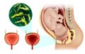 UTI or urinary tract infection during pregnancy. Acute and Interstitial cystitis. Urology. Bladder Infection